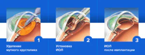 Офтальмологическая клиника «Доктор Цыганок» в Воронеже - микрохирургия, оптика, взрослый и детский офтальмолог | Лечение катаракты Операция по удалению катаракты в Воронеже в клинике Доктор Цыганок