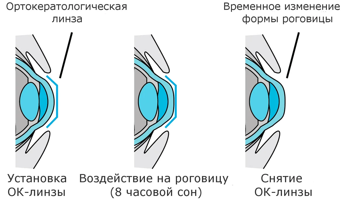 как работает ночная линза